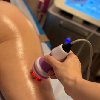 лазерно подмладяване лазерно подмладяване